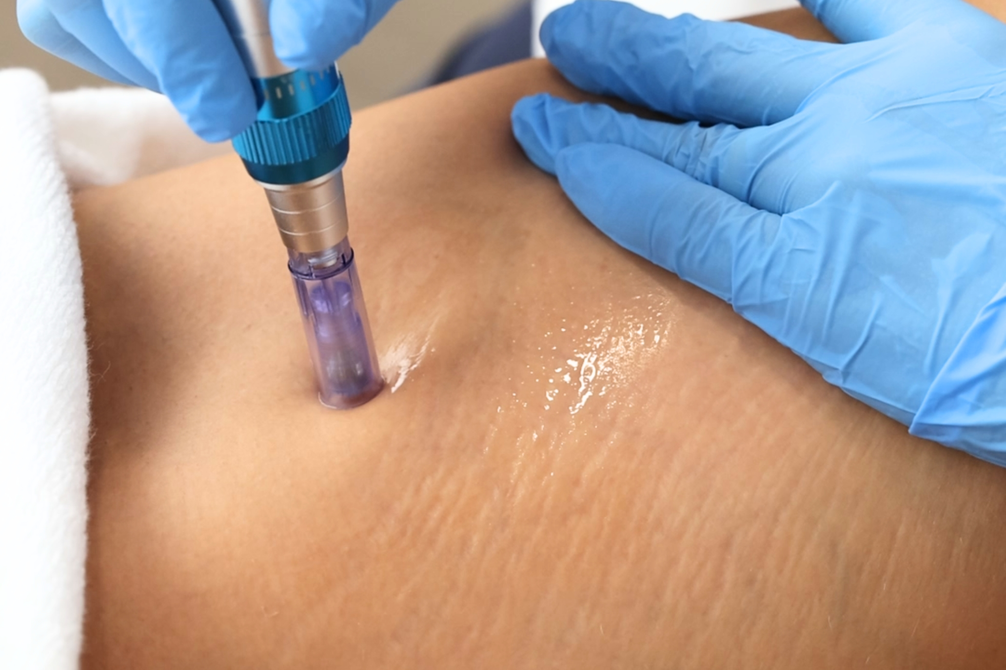 Dermapen_Tratamento Estético_Marco de Canaveses_FisioFeel