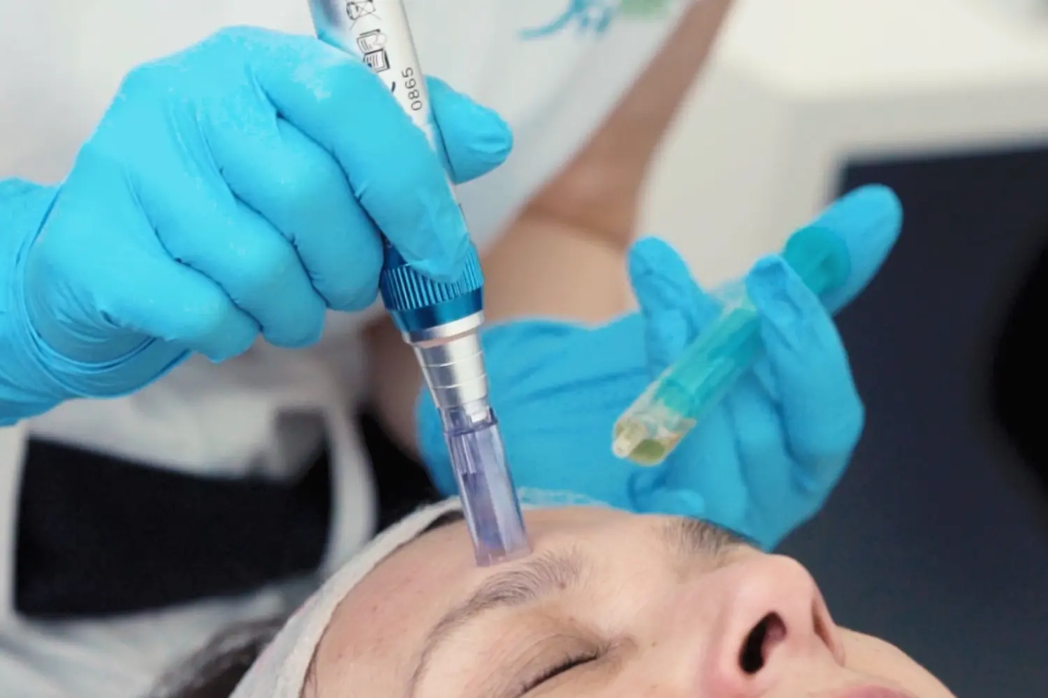 Microagulhamento_Tratamento Estético_Marco de Canaveses_FisioFeel_novo