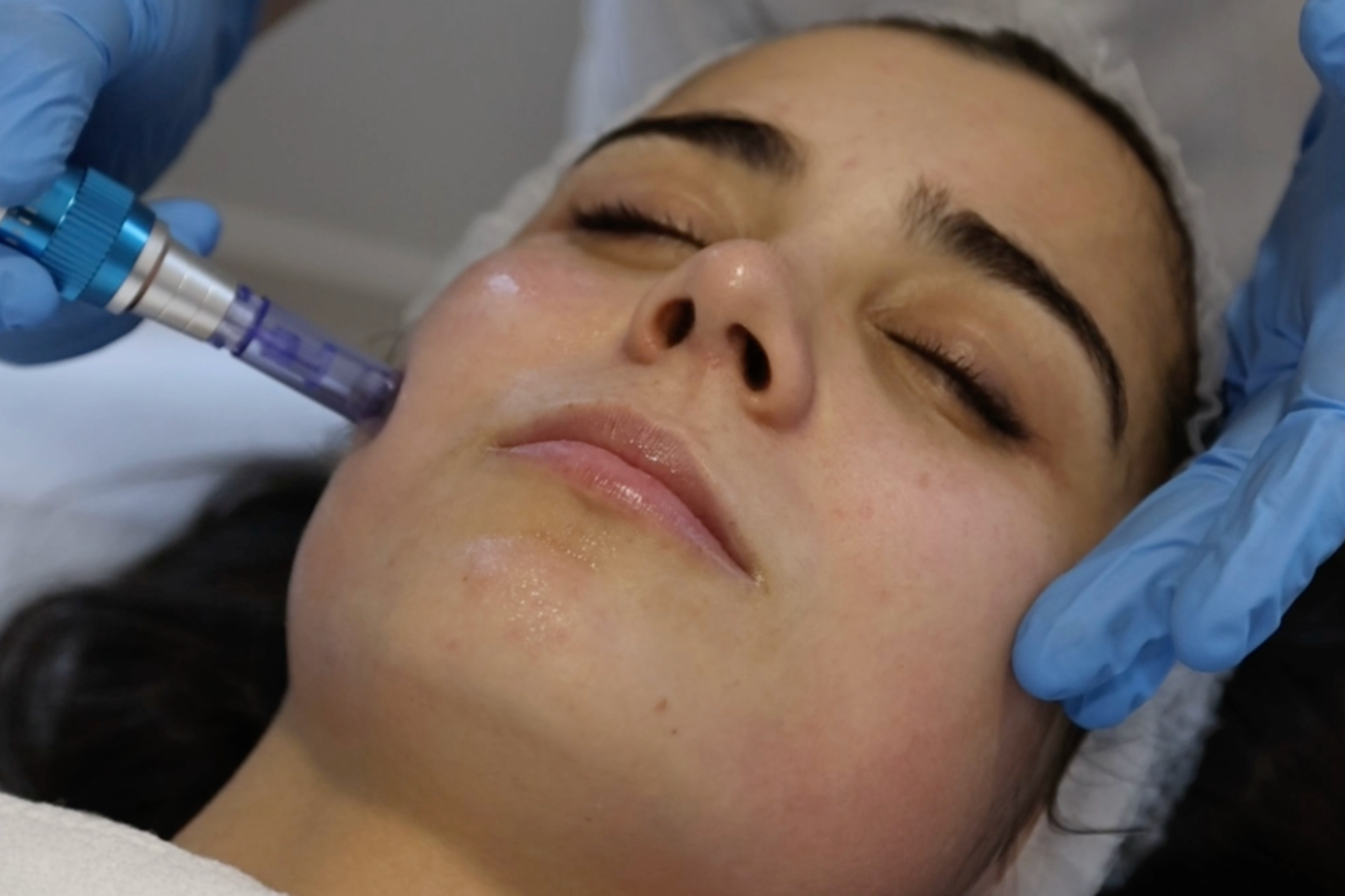 Peeling Químico_Tratamento Estético_Marco de Canaveses_FisioFeel