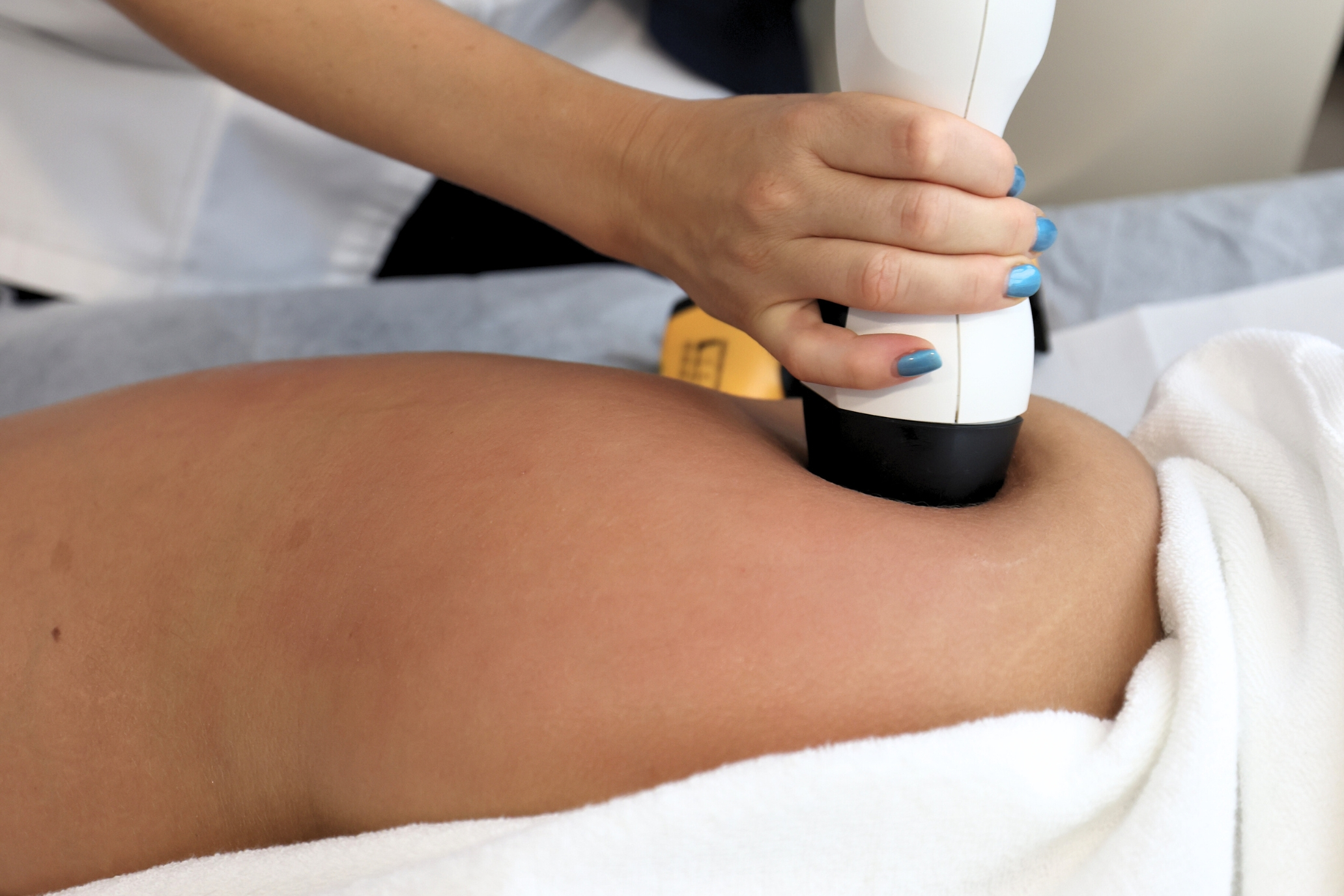 Radiofrequência_Tratamento Estético_Marco de Canaveses_FisioFeel