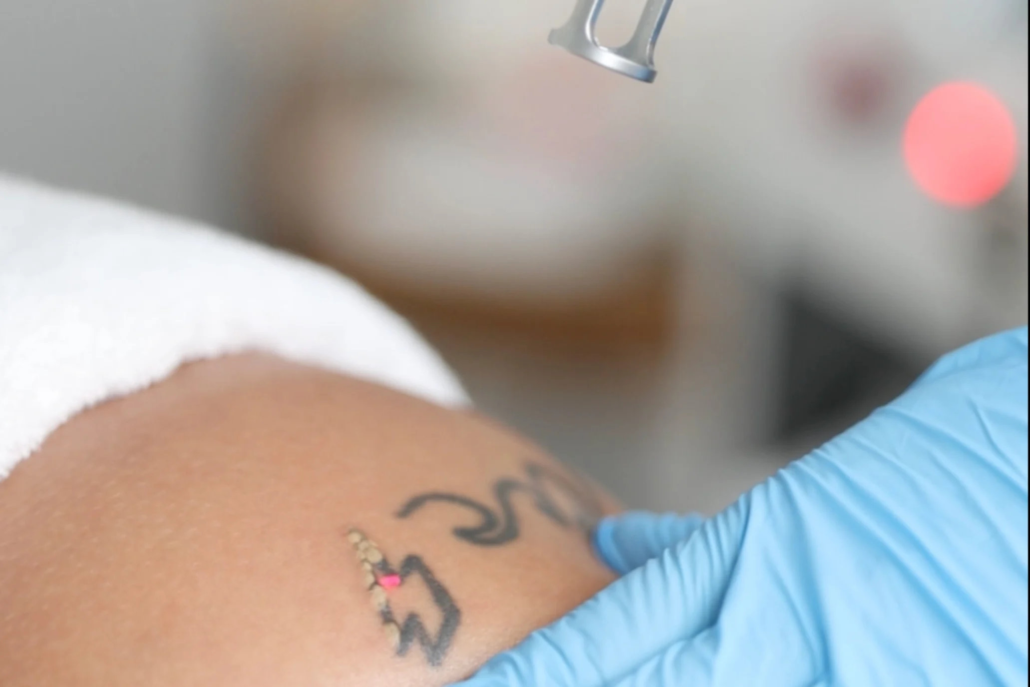 Remoção de Tatuagem_Tratamento Estético_Marco de Canaveses_FisioFeel