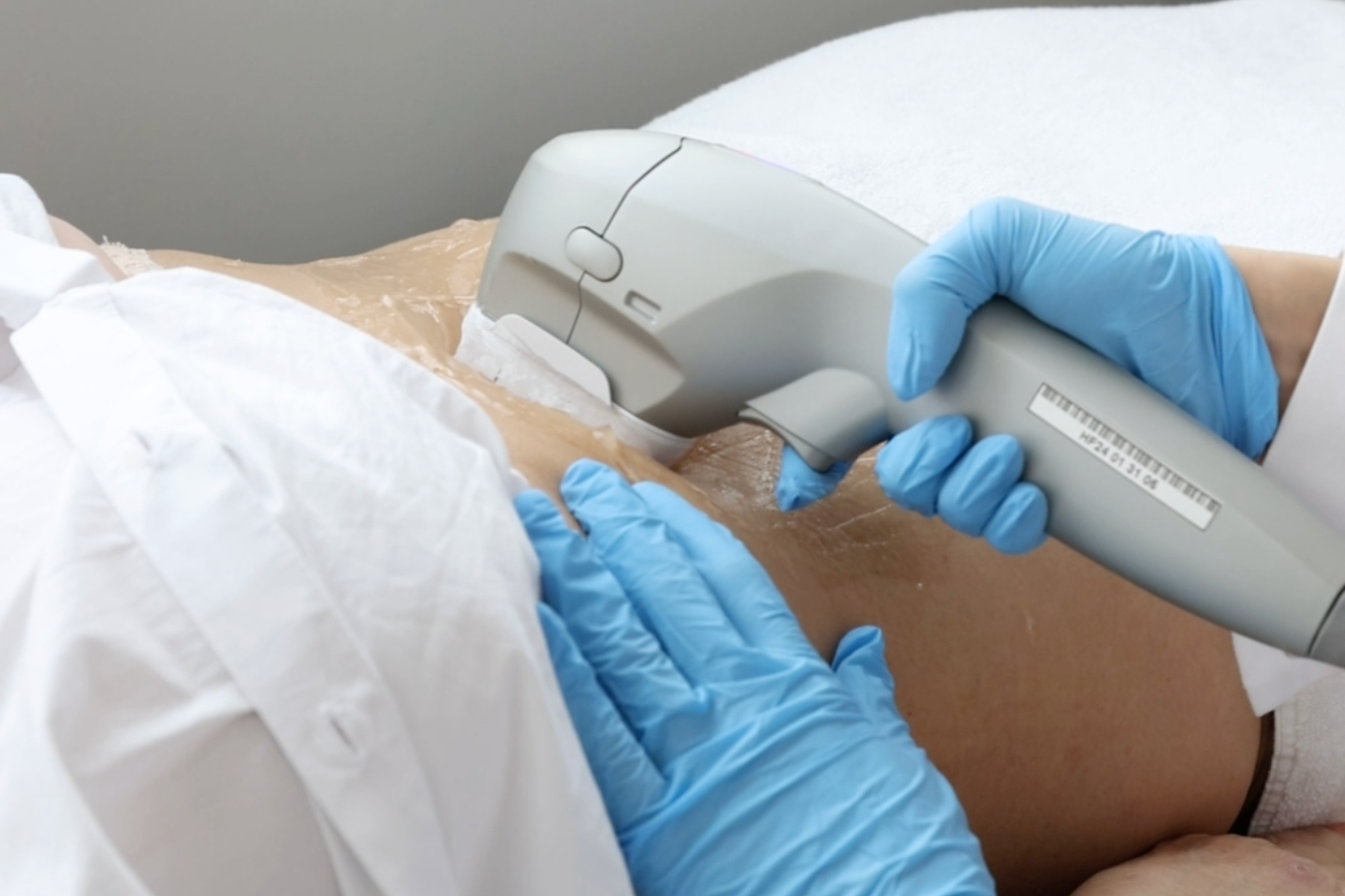 Ultraformer III_Tratamento Estético_Marco de Canaveses_FisioFeel